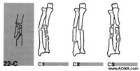 complex fracture of the ulna