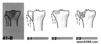 xtra-articular fracture, metaphyseal 
multifragmentary